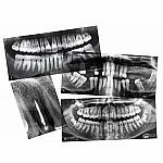 Dental X-Rays 